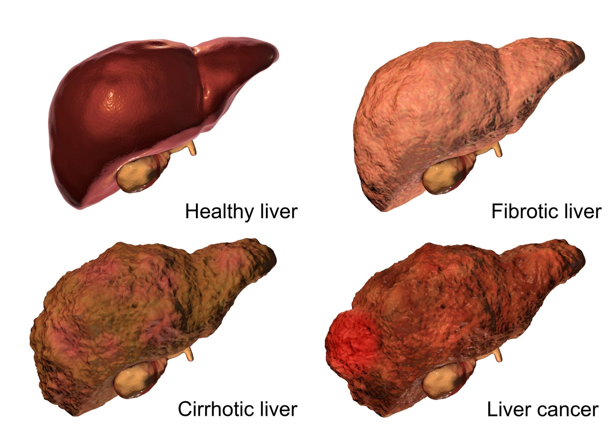 High Ammonia Levels - Fibrotic Liver 