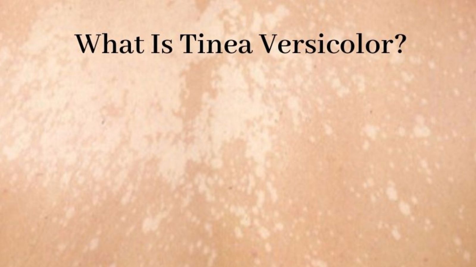  Is Tinea Versicolor Contagious - Tinea Versicolor Rash